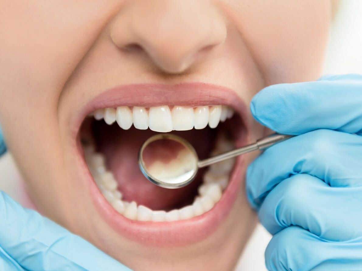 Les maladies bucco-dentaires qui se propagent par les baisers, les caries et la salive