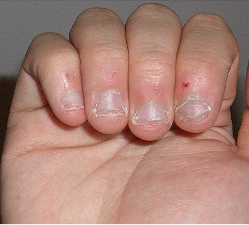 Onychophagie. Quels sont les risques pour la santé de se ronger les ongles ?